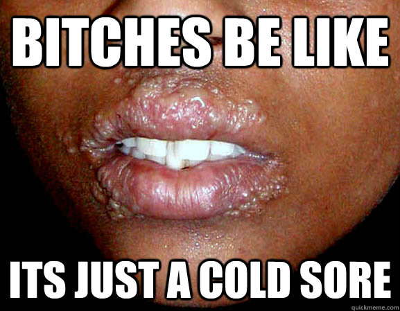 BITCHES BE LIKE ITS JUST A COLD SORE  Thats not a cold sore