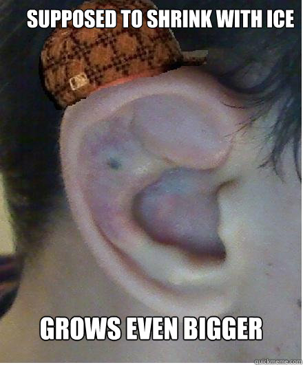 Supposed to shrink with ice Grows Even Bigger - Supposed to shrink with ice Grows Even Bigger  Scumbag Cauliflower ear