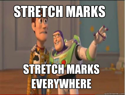 Stretch Marks Stretch Marks everywhere - Stretch Marks Stretch Marks everywhere  woody and buzz