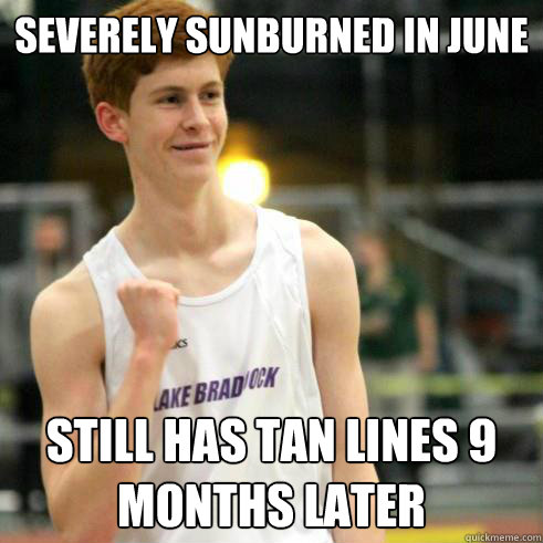 severely sunburned in June still has tan lines 9 months later  Success Ginger