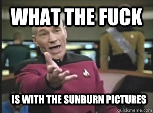 What the fuck Is with the sunburn pictures  Annoyed Picard