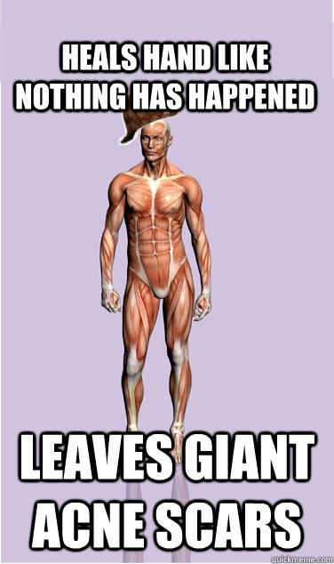 Heals Hand like nothing has happened Leaves giant acne scars - Heals Hand like nothing has happened Leaves giant acne scars  Misc
