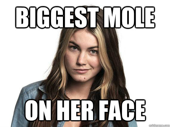Biggest Mole On her Face  Cheryl Mole