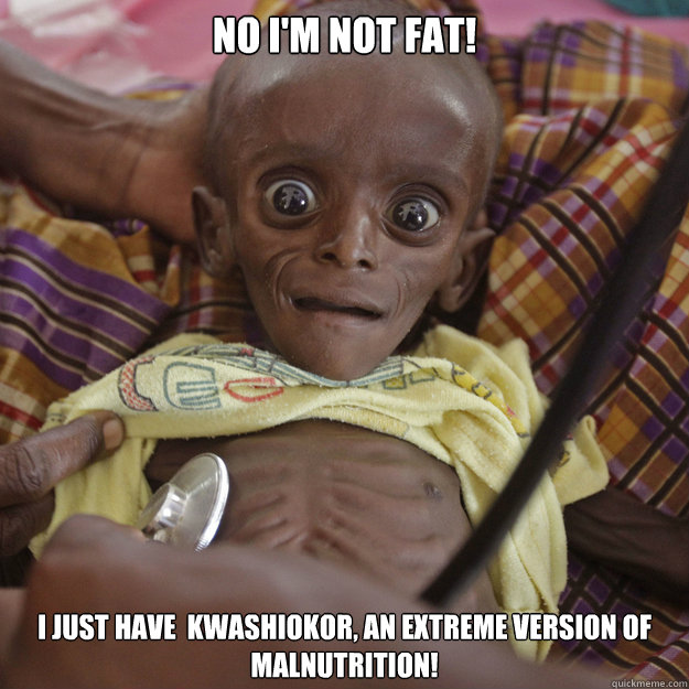 No I'm not fat! I just have  Kwashiokor, an extreme version of malnutrition!  