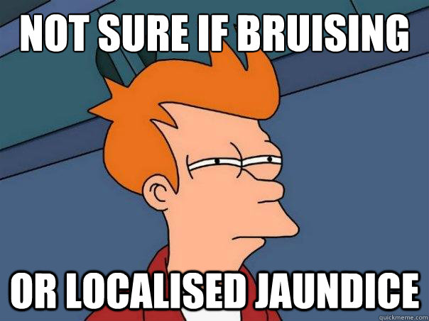Not sure if bruising or localised jaundice  Futurama Fry