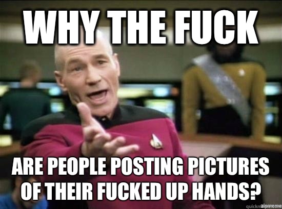 Why the fuck are people posting pictures of their fucked up hands?  Annoyed Picard HD