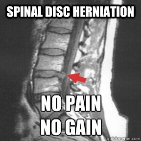 Spinal disc herniation NO PAIN 
NO GAIN - Spinal disc herniation NO PAIN 
NO GAIN  NO PAIN NO GAIN