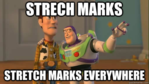 Strech marks Stretch marks everywhere  Everywhere
