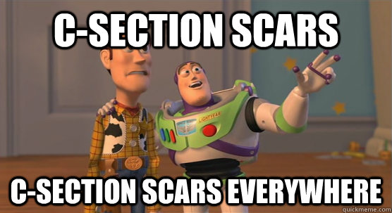 c-section scars c-section scars everywhere  Toy Story Everywhere