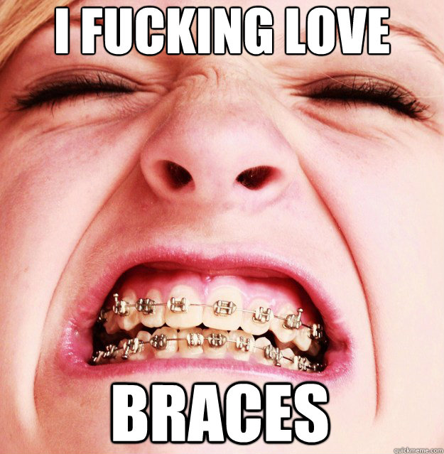 I FUCKING LOVE Braces  Braces Girl