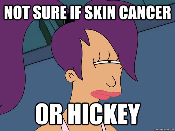 Not sure if skin cancer or hickey  Leela Futurama