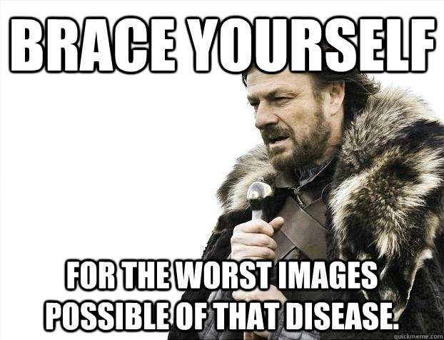 brace yourself for the worst images possible of that disease.   BRACEYOSELVES