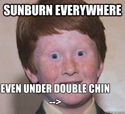 Sunburn everywhere even under double chin 
--> - Sunburn everywhere even under double chin 
-->  Over Confident Ginger