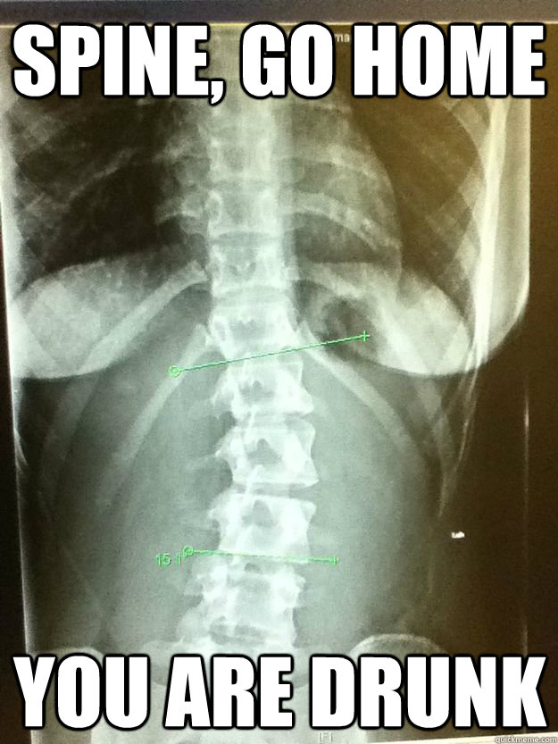 spine, go home you are drunk  scoliosis