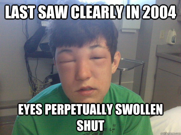 last saw clearly in 2004 eyes perpetually swollen shut  