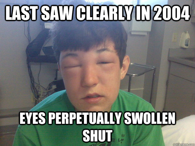 last saw clearly in 2004 eyes perpetually swollen shut - last saw clearly in 2004 eyes perpetually swollen shut  Allergic to Everything