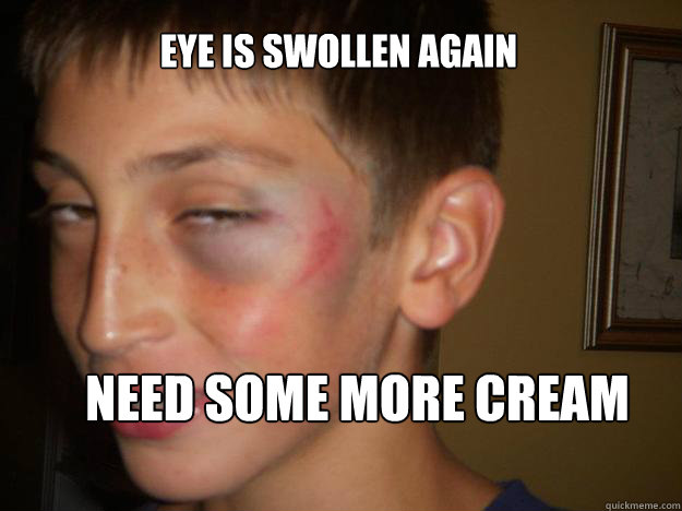 eye is swollen again need some more cream - eye is swollen again need some more cream  david blackeye